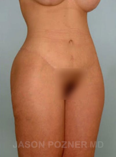 Body Lift Before & After Gallery - Patient 17932075 - Image 4
