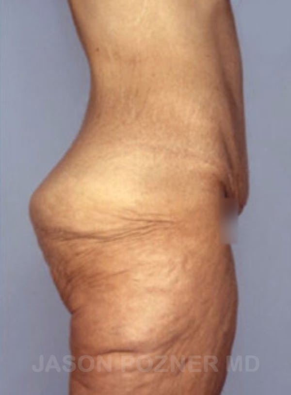 Body Lift Before & After Gallery - Patient 17932075 - Image 5