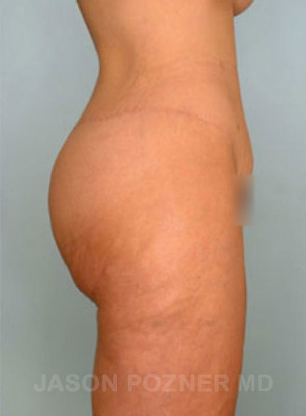 Body Lift Before & After Gallery - Patient 17932075 - Image 6