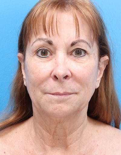 Laser Resurfacing Before & After Gallery - Patient 381821 - Image 1