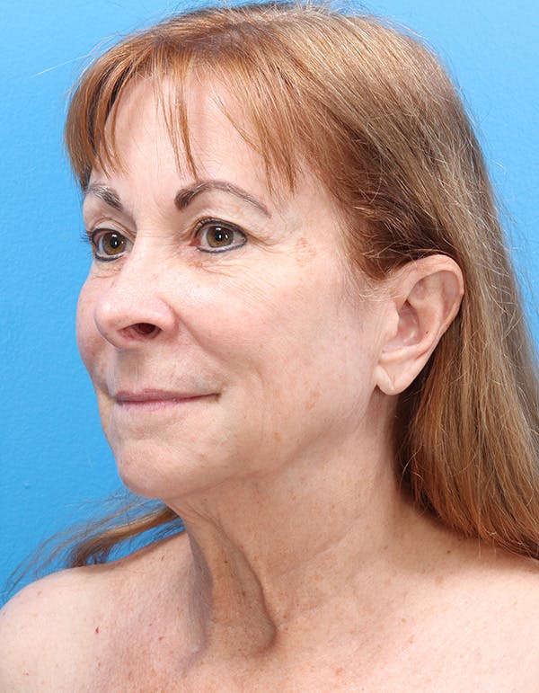 Facelift Before & After Gallery - Patient 519549 - Image 3