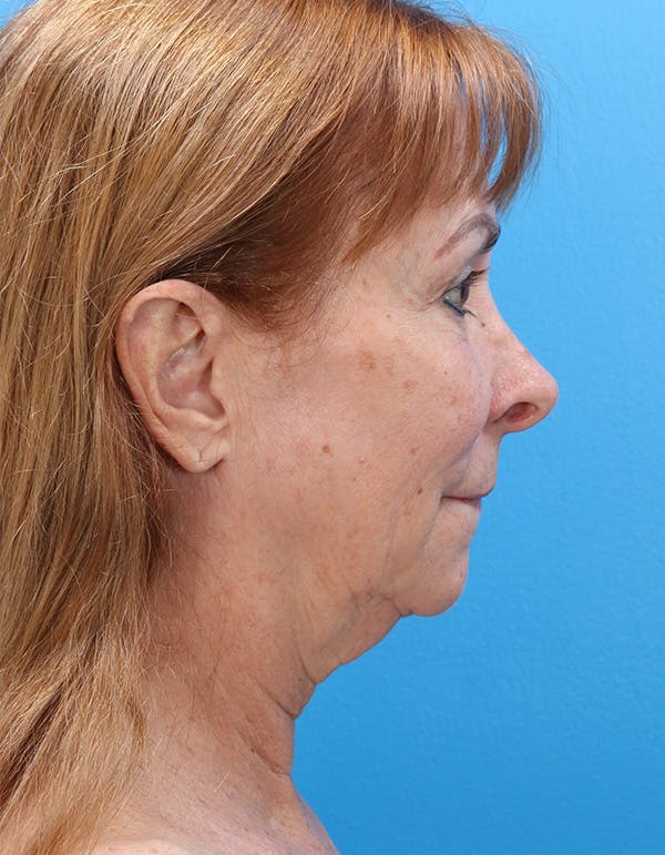 Blepharoplasty Before & After Gallery - Patient 171285 - Image 5