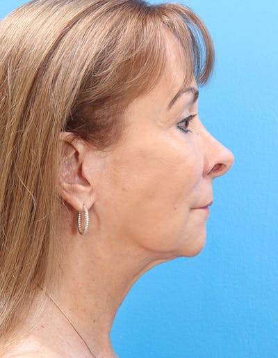 Laser Resurfacing Before & After Gallery - Patient 381821 - Image 6