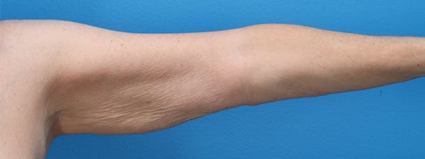 Brachioplasty Before & After Gallery - Patient 307073 - Image 1
