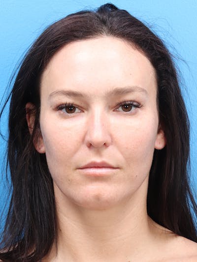 Blepharoplasty Before & After Gallery - Patient 190038 - Image 1