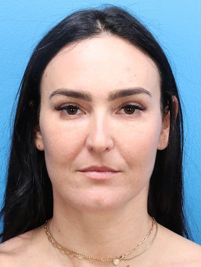 Blepharoplasty Before & After Gallery - Patient 190038 - Image 2