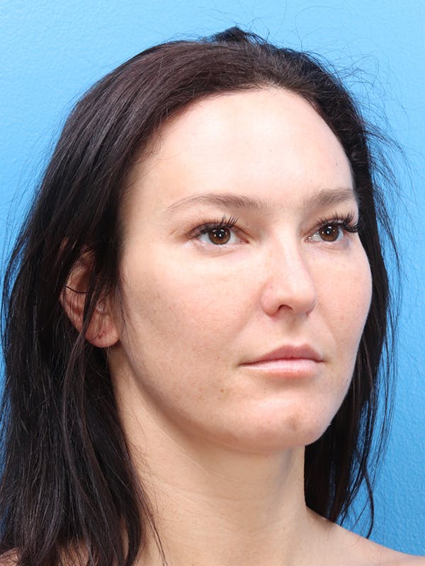 Blepharoplasty Before & After Gallery - Patient 190038 - Image 3