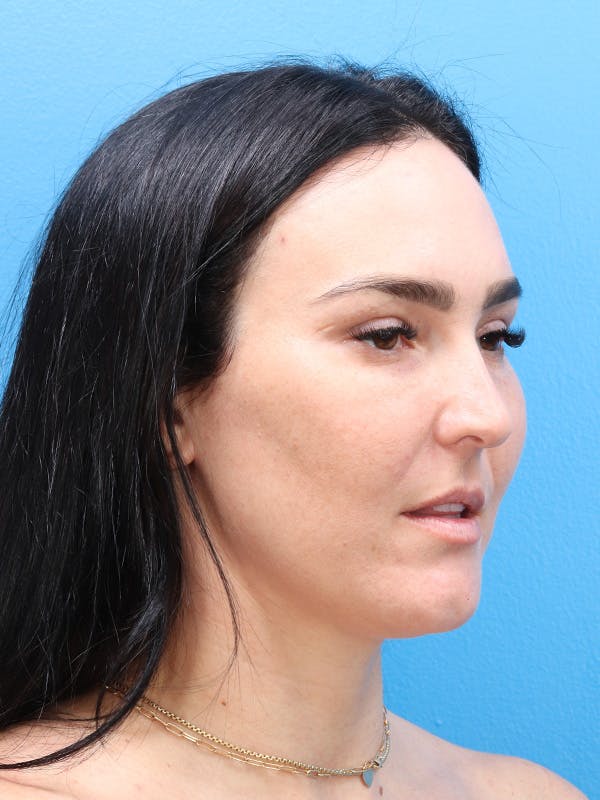 Blepharoplasty Before & After Gallery - Patient 190038 - Image 4