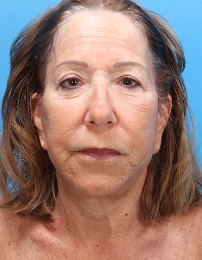 Laser Resurfacing Before & After Gallery - Patient 619745 - Image 1