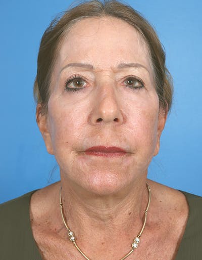 Laser Resurfacing Before & After Gallery - Patient 619745 - Image 2
