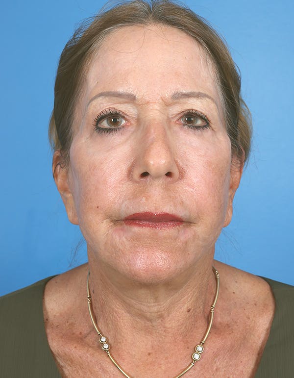 Laser Resurfacing Before & After Gallery - Patient 619745 - Image 2