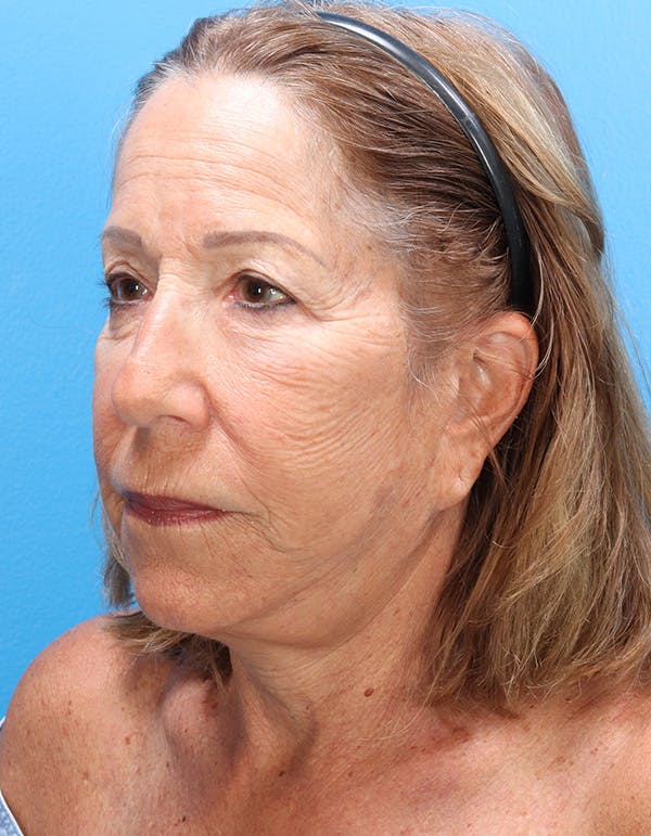 Laser Resurfacing Before & After Gallery - Patient 619745 - Image 3