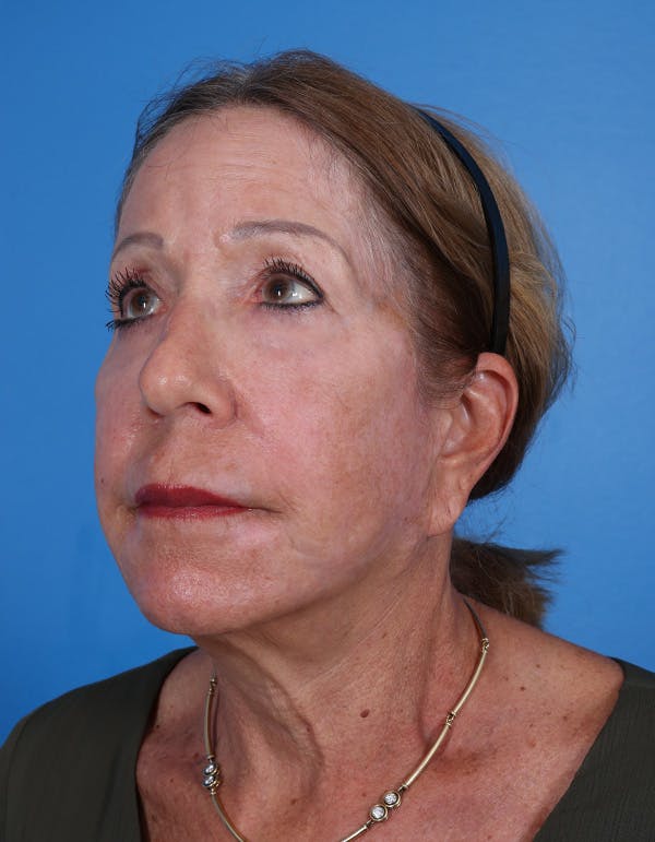 Laser Resurfacing Before & After Gallery - Patient 619745 - Image 4