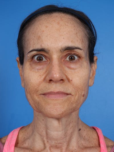 Blepharoplasty Before & After Gallery - Patient 268584 - Image 1