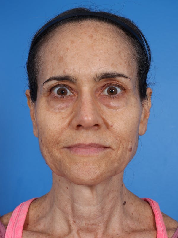 Laser Resurfacing Before & After Gallery - Patient 412245 - Image 1