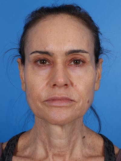 Blepharoplasty Before & After Gallery - Patient 268584 - Image 2