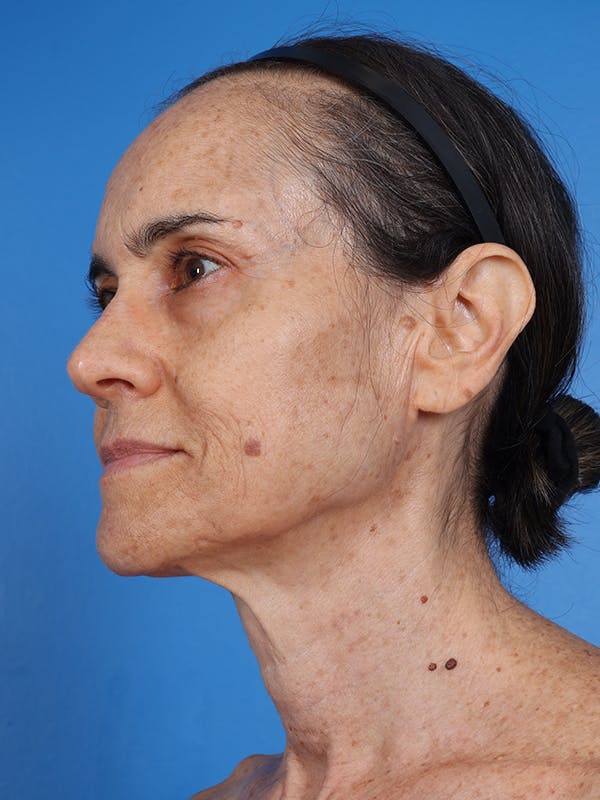 Laser Resurfacing Before & After Gallery - Patient 412245 - Image 3