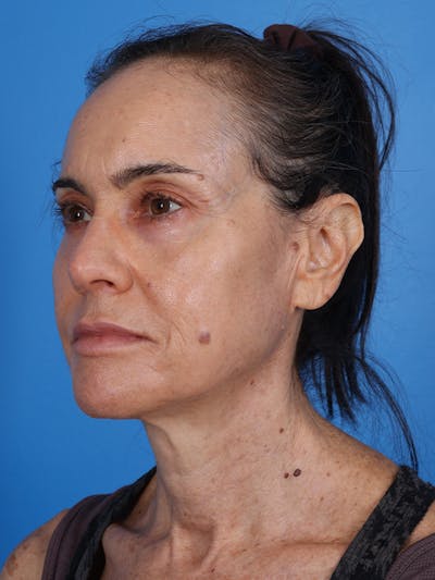 Laser Resurfacing Before & After Gallery - Patient 412245 - Image 4
