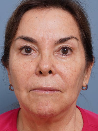 MyEllevate™ Before & After Gallery - Patient 435772 - Image 1