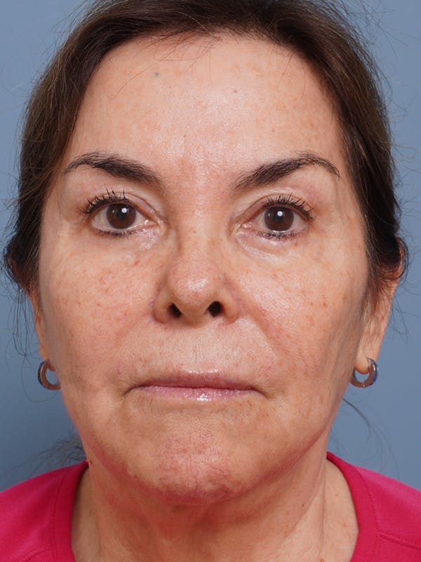 MyEllevate™ Before & After Gallery - Patient 435772 - Image 1