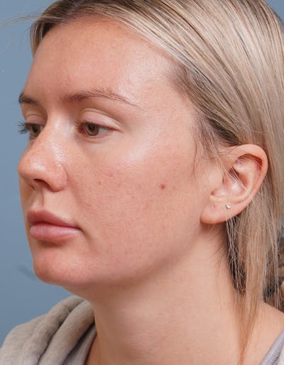 Liposuction Before & After Gallery - Patient 320338 - Image 1