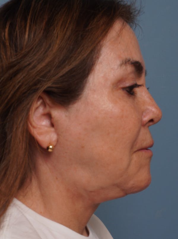 MyEllevate™ Before & After Gallery - Patient 435772 - Image 4