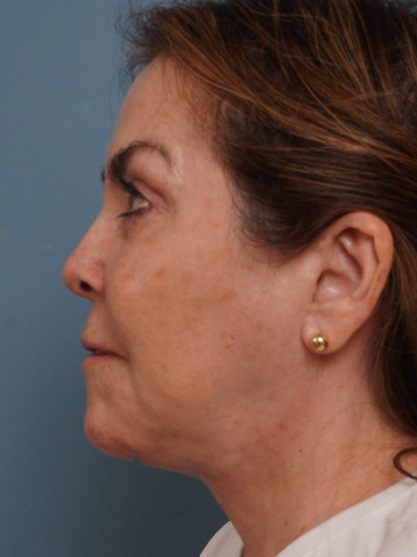 MyEllevate™ Before & After Gallery - Patient 435772 - Image 6