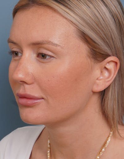 Liposuction Before & After Gallery - Patient 320338 - Image 2