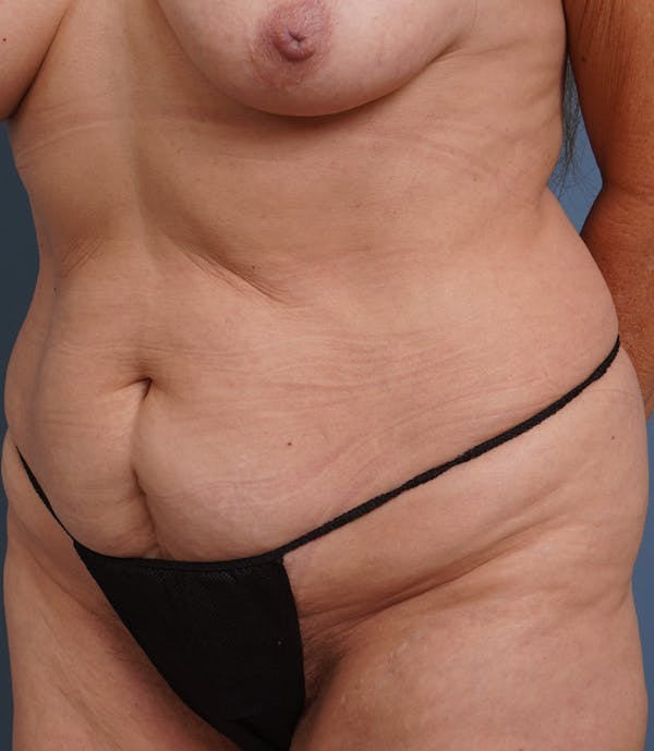 Liposuction Before & After Gallery - Patient 408462 - Image 5