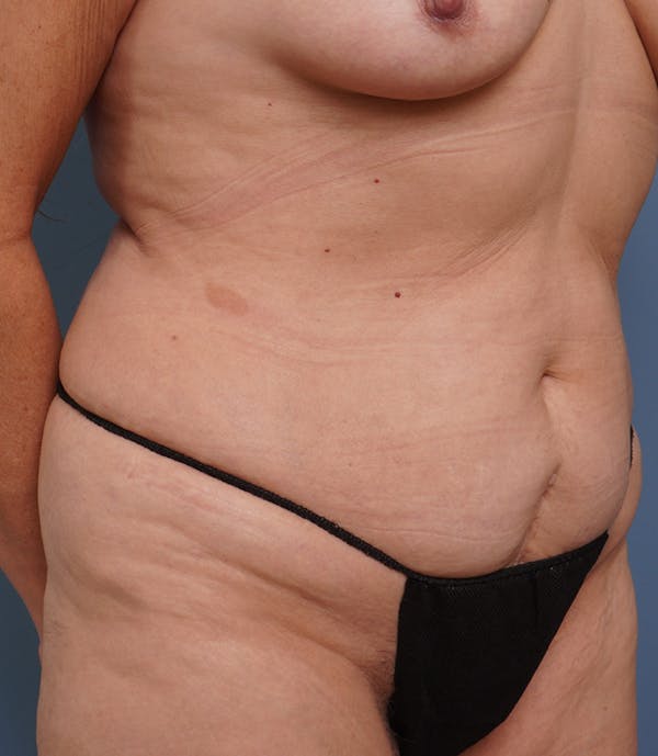 Liposuction Before & After Gallery - Patient 408462 - Image 3
