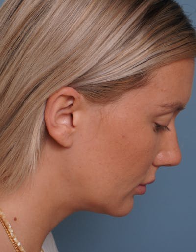 MyEllevate™ Before & After Gallery - Patient 715824 - Image 8