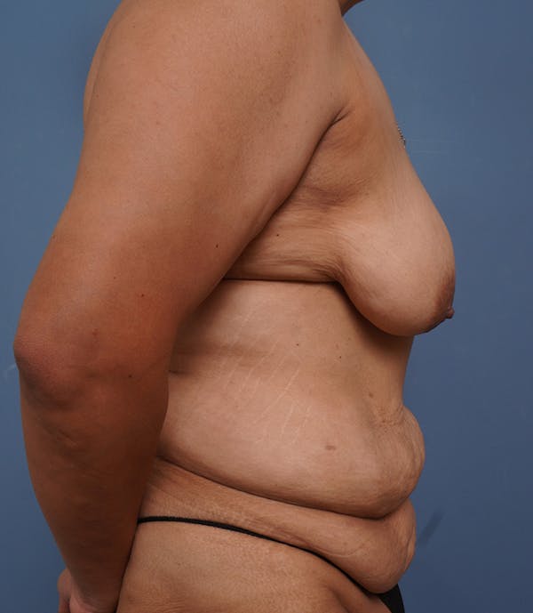 Tummy Tuck Before & After Gallery - Patient 424551 - Image 5