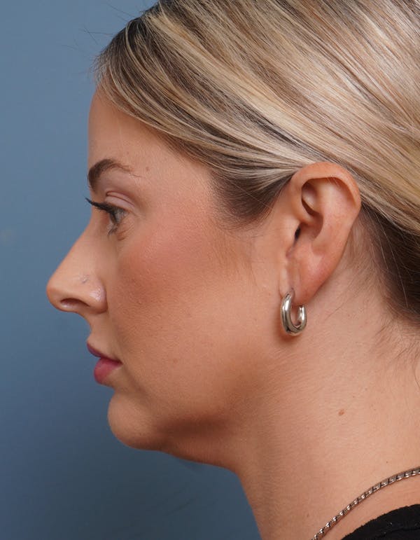 MyEllevate™ Before & After Gallery - Patient 715824 - Image 5
