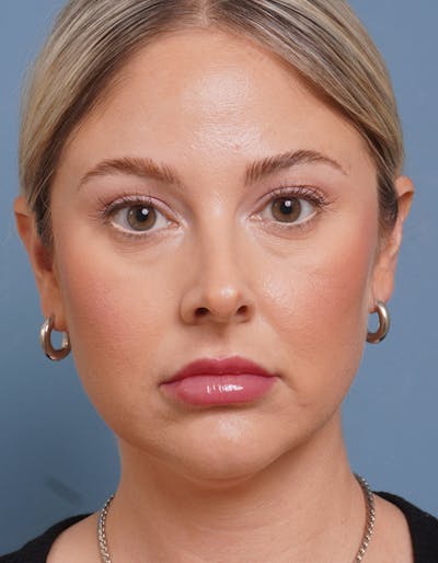 Liposuction Before & After Gallery - Patient 284998 - Image 1