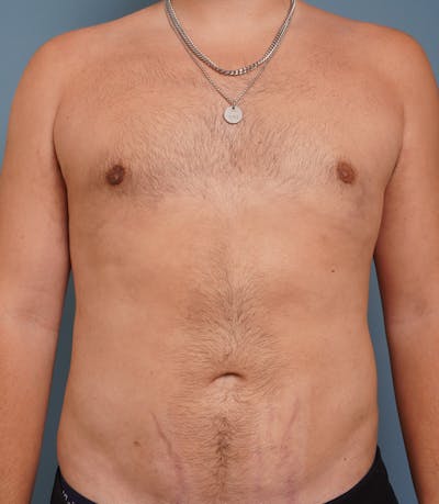 Liposuction Before & After Gallery - Patient 154439 - Image 2