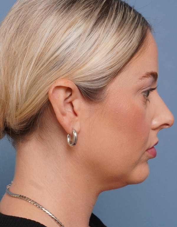 MyEllevate™ Before & After Gallery - Patient 715824 - Image 3