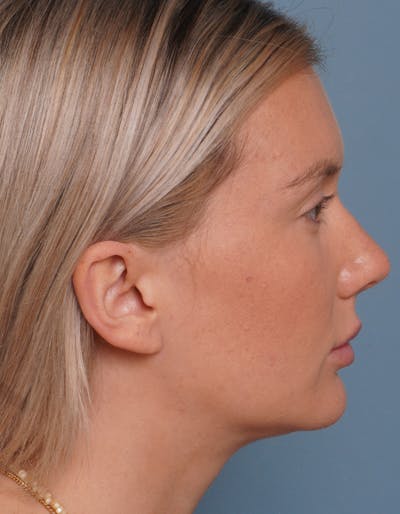 Facial Fat Transfer Before & After Gallery - Patient 452437 - Image 4