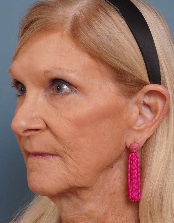 Facial Fat Transfer Before & After Gallery - Patient 452437 - Image 6