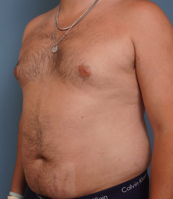 Liposuction Before & After Gallery - Patient 154439 - Image 7
