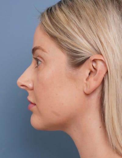 MyEllevate™ Before & After Gallery - Patient 715824 - Image 6