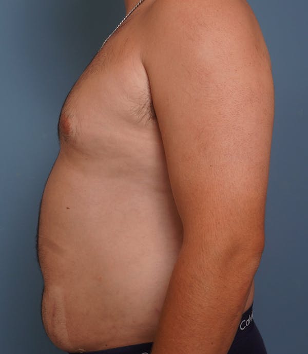 Liposuction Before & After Gallery - Patient 154439 - Image 9