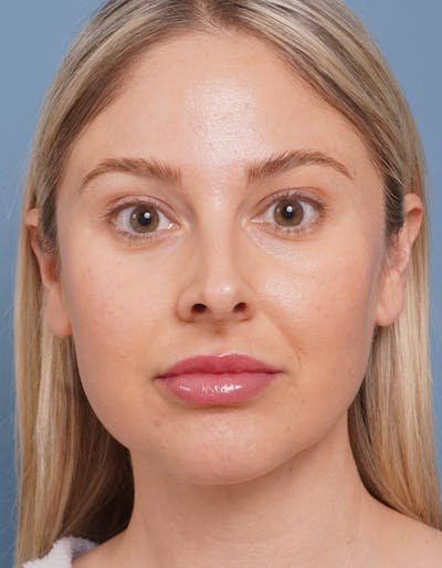 Liposuction Before & After Gallery - Patient 284998 - Image 2