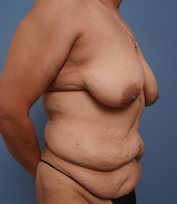 Tummy Tuck Before & After Gallery - Patient 424551 - Image 3