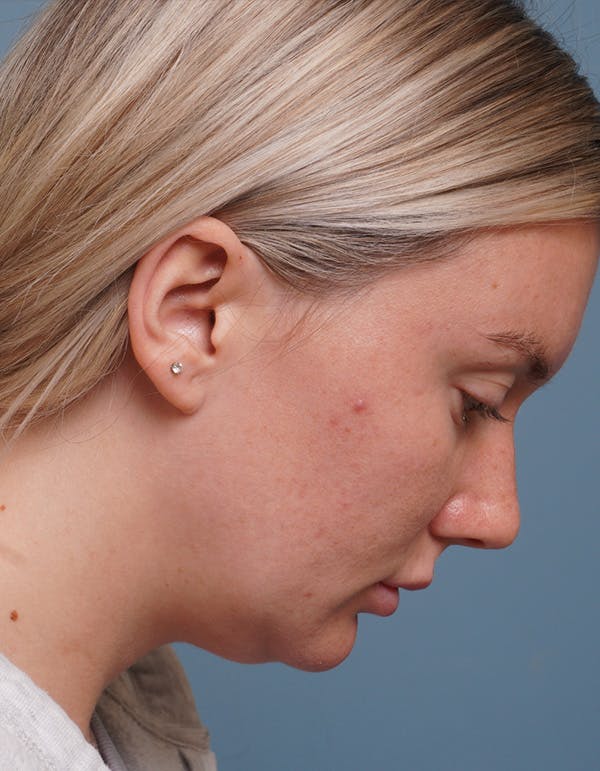 Liposuction Before & After Gallery - Patient 320338 - Image 5