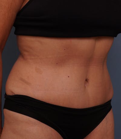 Liposuction Before & After Gallery - Patient 408462 - Image 4