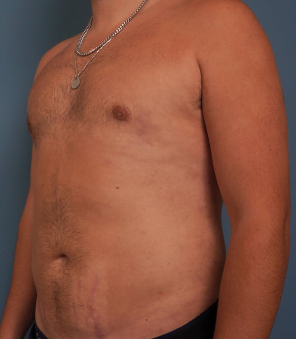 Liposuction Before & After Gallery - Patient 154439 - Image 8