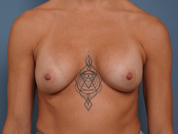 Breast Augmentation Before & After Gallery - Patient 140881 - Image 2