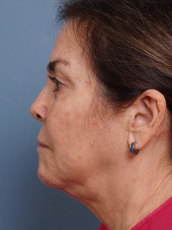 MyEllevate™ Before & After Gallery - Patient 435772 - Image 5