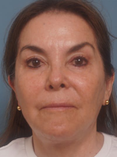 MyEllevate™ Before & After Gallery - Patient 435772 - Image 2