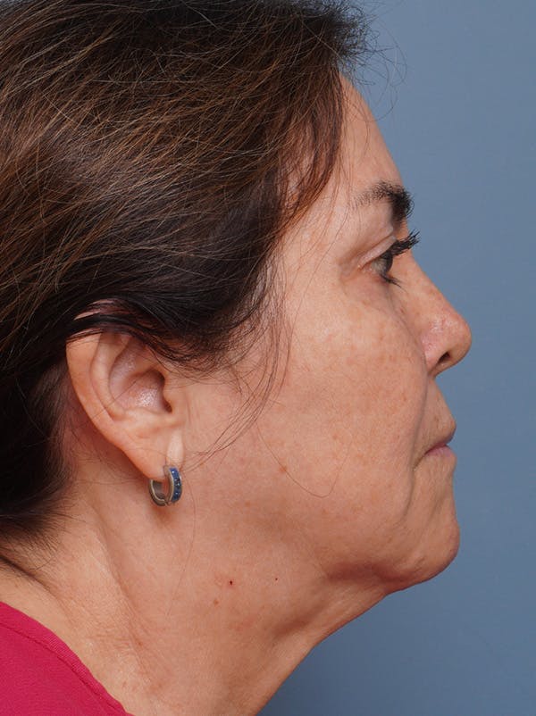 MyEllevate™ Before & After Gallery - Patient 435772 - Image 3